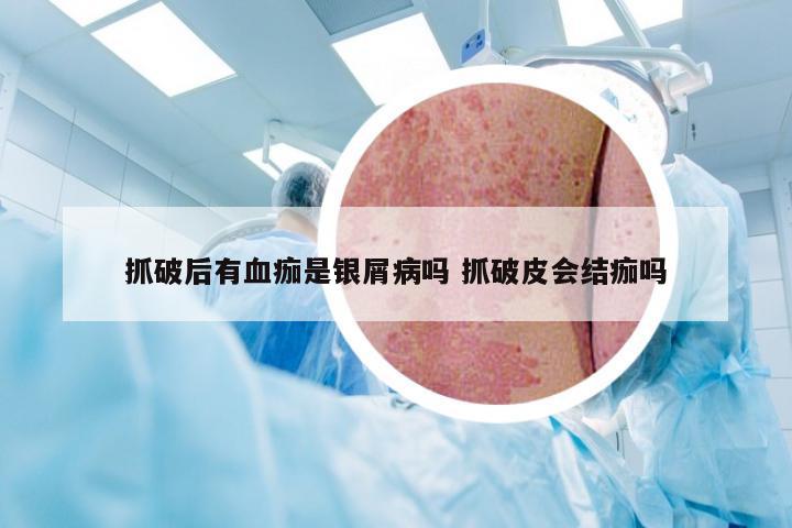 抓破后有血痂是银屑病吗 抓破皮会结痂吗