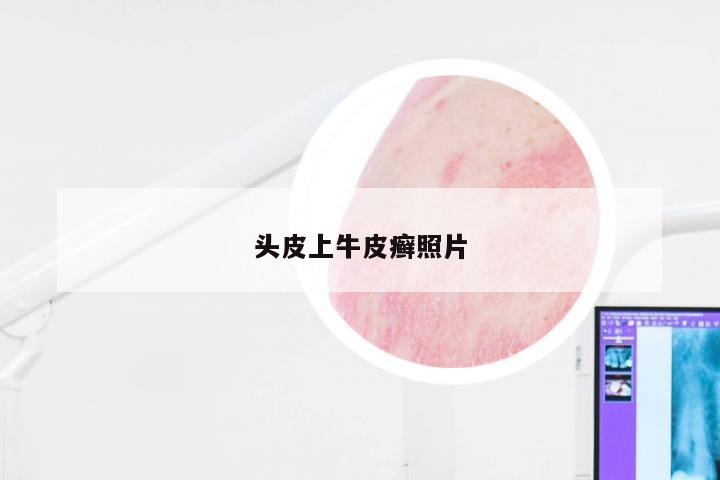 头皮上牛皮癣照片