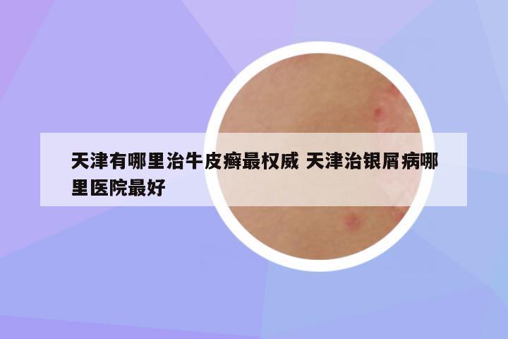 天津有哪里治牛皮癣最权威 天津治银屑病哪里医院最好