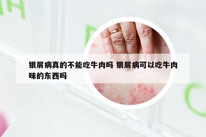 银屑病真的不能吃牛肉吗 银屑病可以吃牛肉味的东西吗