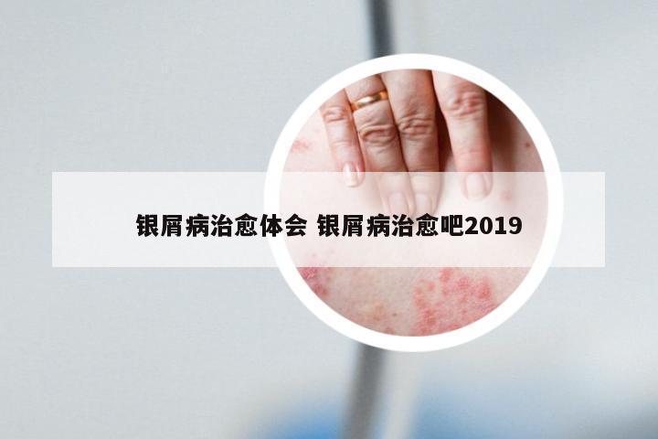 银屑病治愈体会 银屑病治愈吧2019