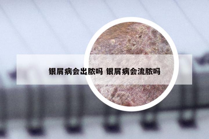 银屑病会出脓吗 银屑病会流脓吗