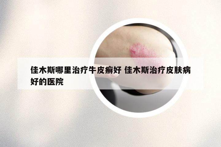 佳木斯哪里治疗牛皮癣好 佳木斯治疗皮肤病好的医院