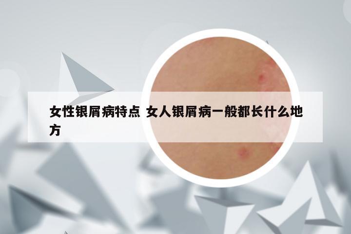 女性银屑病特点 女人银屑病一般都长什么地方