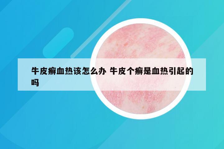 牛皮癣血热该怎么办 牛皮个癣是血热引起的吗