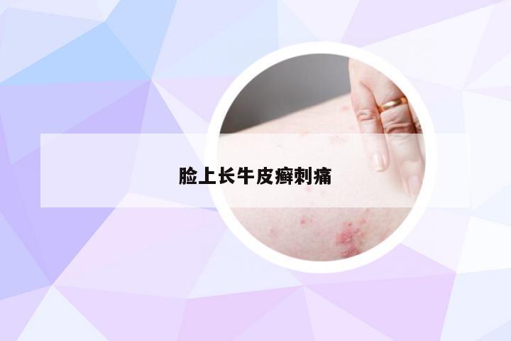 脸上长牛皮癣刺痛
