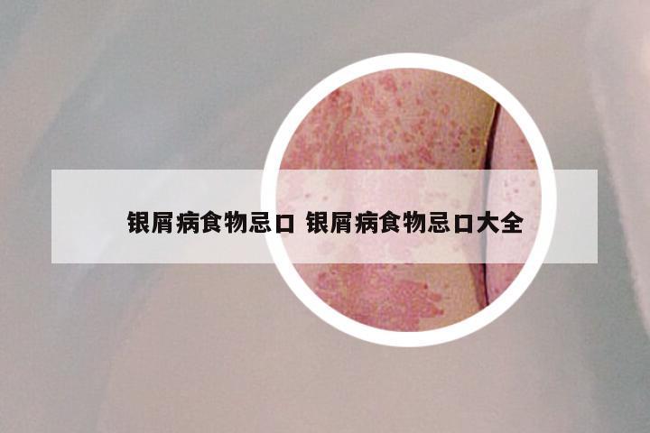 银屑病食物忌口 银屑病食物忌口大全