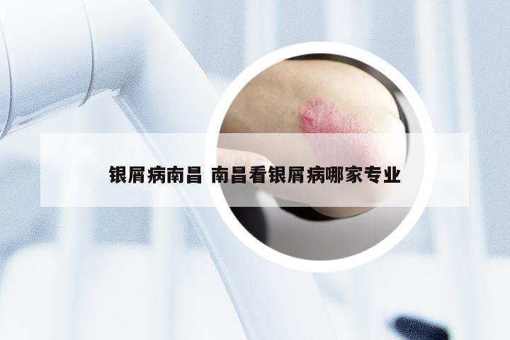 银屑病南昌 南昌看银屑病哪家专业