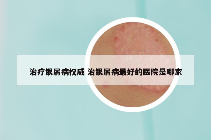 治疗银屑病权威 治银屑病最好的医院是哪家