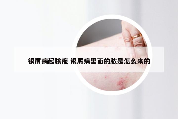 银屑病起脓疱 银屑病里面的脓是怎么来的