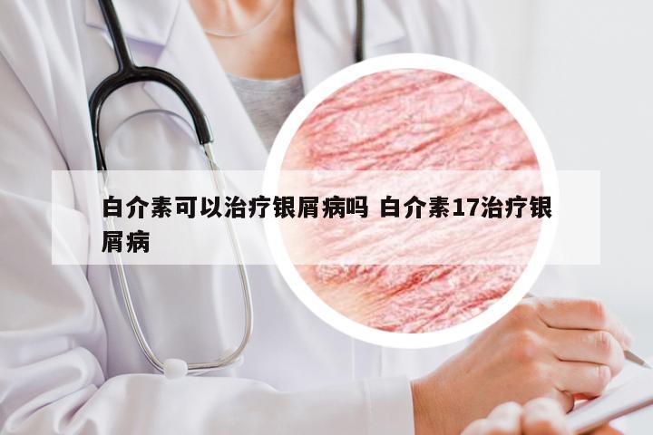 白介素可以治疗银屑病吗 白介素17治疗银屑病