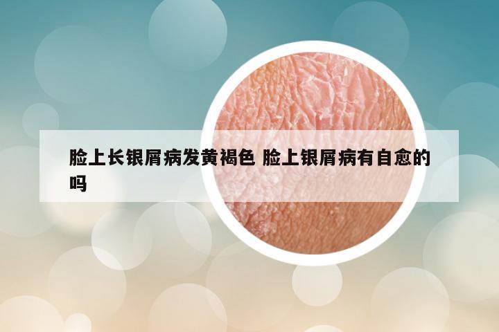 脸上长银屑病发黄褐色 脸上银屑病有自愈的吗