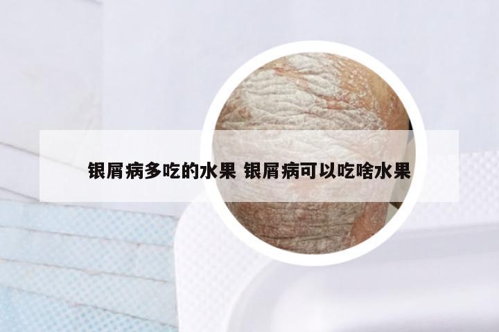 银屑病多吃的水果 银屑病可以吃啥水果