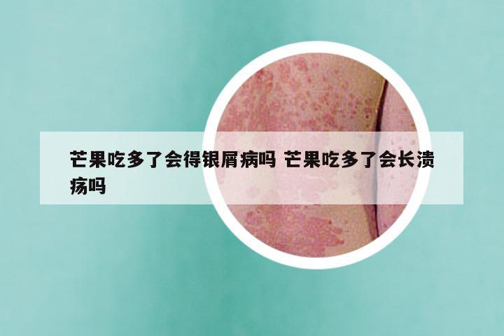 芒果吃多了会得银屑病吗 芒果吃多了会长溃疡吗