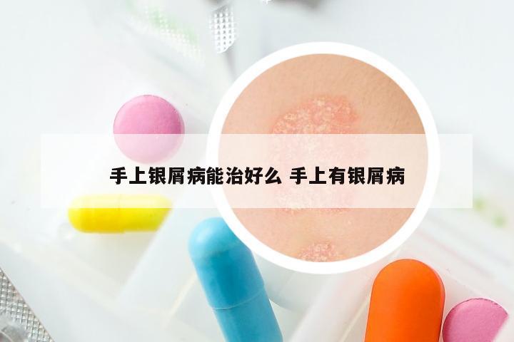 手上银屑病能治好么 手上有银屑病