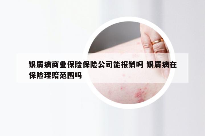 银屑病商业保险保险公司能报销吗 银屑病在保险理赔范围吗