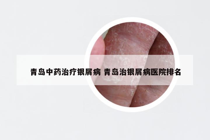 青岛中药治疗银屑病 青岛治银屑病医院排名