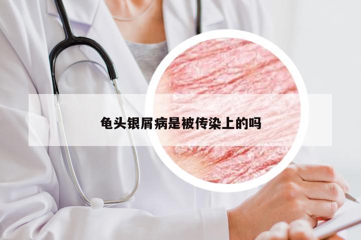 龟头银屑病是被传染上的吗