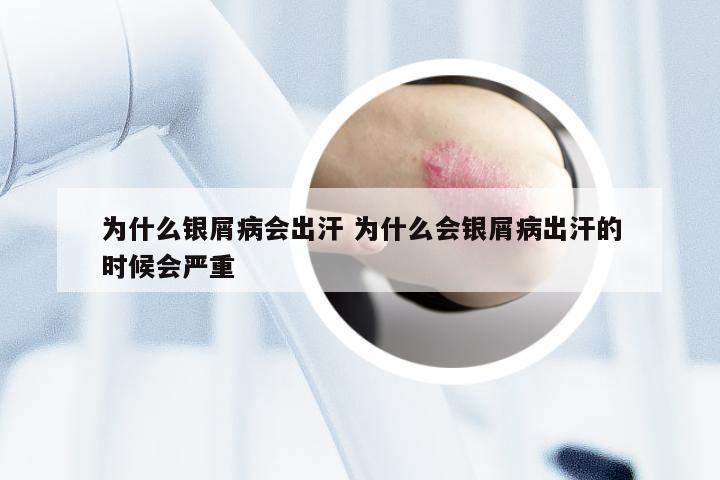 为什么银屑病会出汗 为什么会银屑病出汗的时候会严重