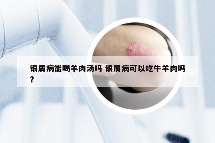 银屑病能喝羊肉汤吗 银屑病可以吃牛羊肉吗?