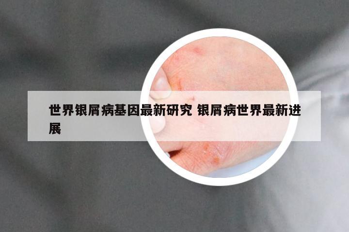 世界银屑病基因最新研究 银屑病世界最新进展