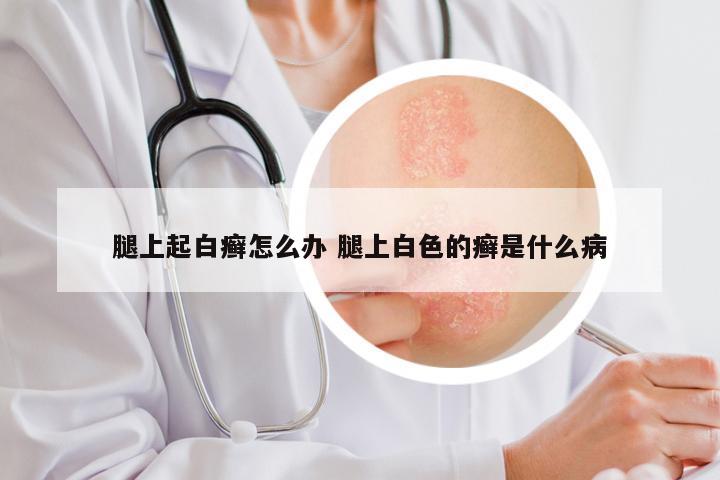 腿上起白癣怎么办 腿上白色的癣是什么病