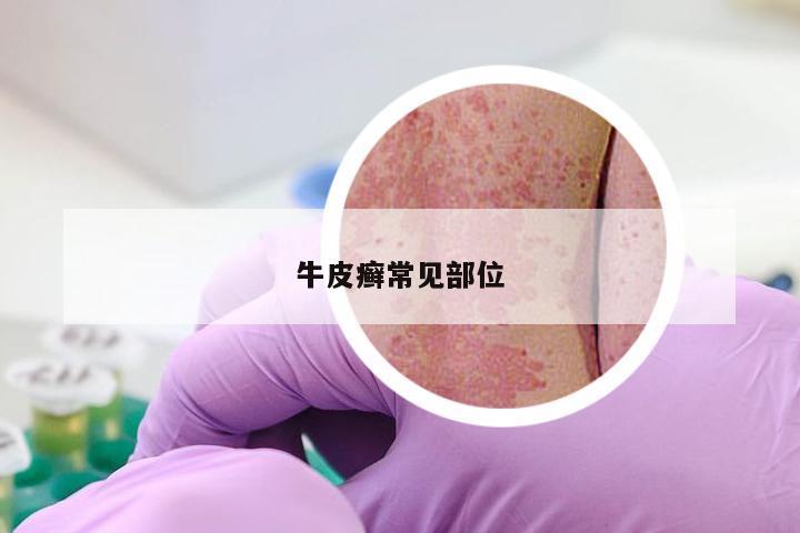 牛皮癣常见部位