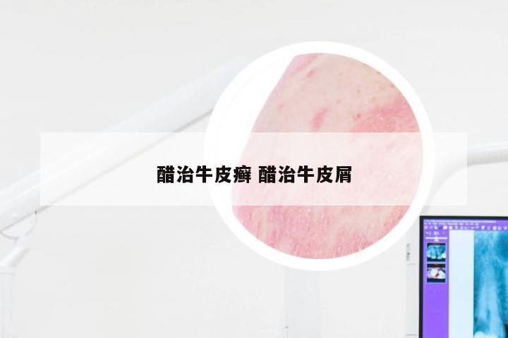 醋治牛皮癣 醋治牛皮屑
