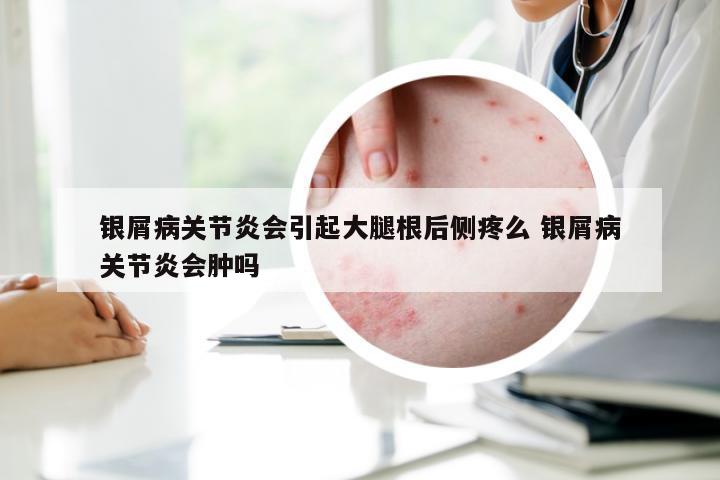银屑病关节炎会引起大腿根后侧疼么 银屑病关节炎会肿吗