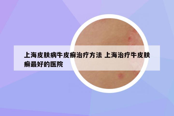 上海皮肤病牛皮癣治疗方法 上海治疗牛皮肤癣最好的医院