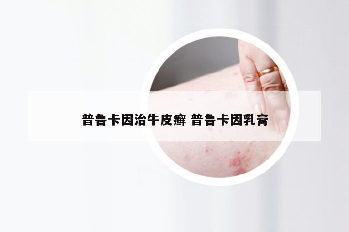 普鲁卡因治牛皮癣 普鲁卡因乳膏