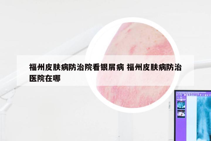 福州皮肤病防治院看银屑病 福州皮肤病防治医院在哪