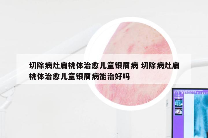 切除病灶扁桃体治愈儿童银屑病 切除病灶扁桃体治愈儿童银屑病能治好吗