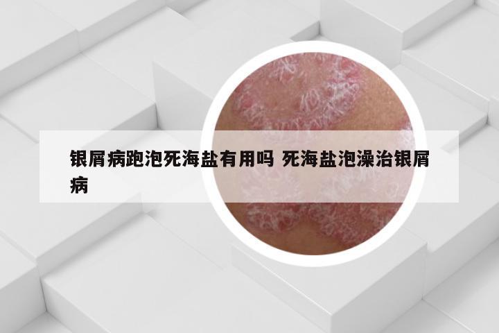 银屑病跑泡死海盐有用吗 死海盐泡澡治银屑病