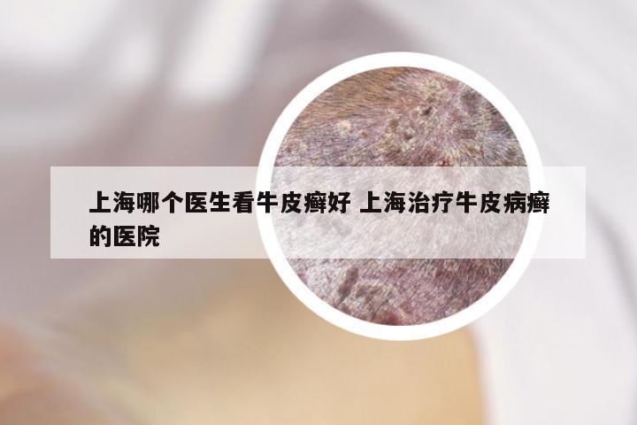上海哪个医生看牛皮癣好 上海治疗牛皮病癣的医院