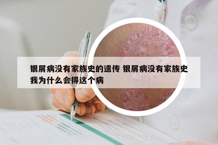 银屑病没有家族史的遗传 银屑病没有家族史我为什么会得这个病