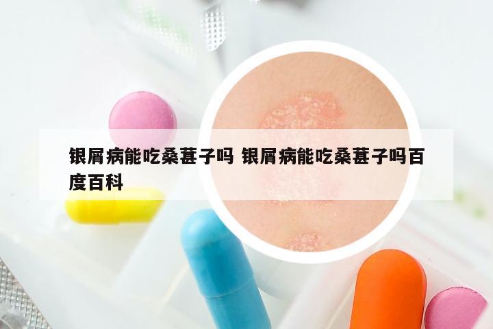 银屑病能吃桑葚子吗 银屑病能吃桑葚子吗百度百科