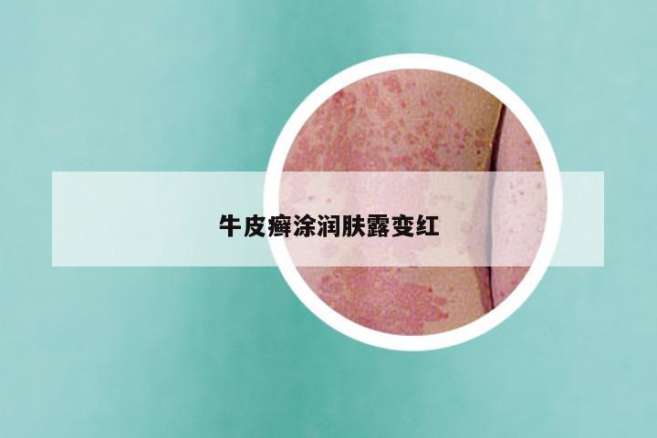 牛皮癣涂润肤露变红