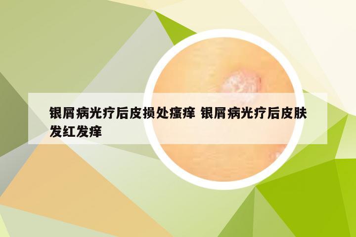 银屑病光疗后皮损处瘙痒 银屑病光疗后皮肤发红发痒