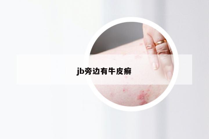 jb旁边有牛皮癣
