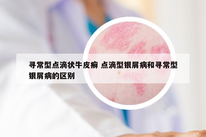 寻常型点滴状牛皮癣 点滴型银屑病和寻常型银屑病的区别