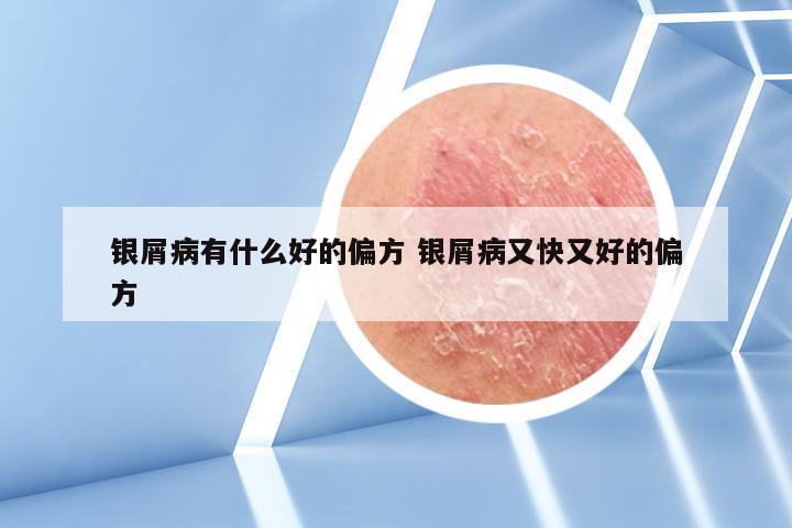 银屑病有什么好的偏方 银屑病又快又好的偏方