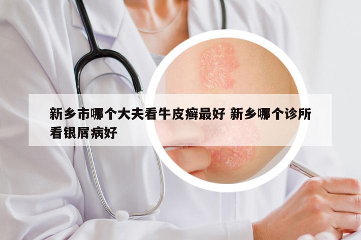 新乡市哪个大夫看牛皮癣最好 新乡哪个诊所看银屑病好