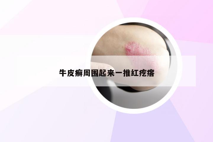 牛皮癣周围起来一推红疙瘩