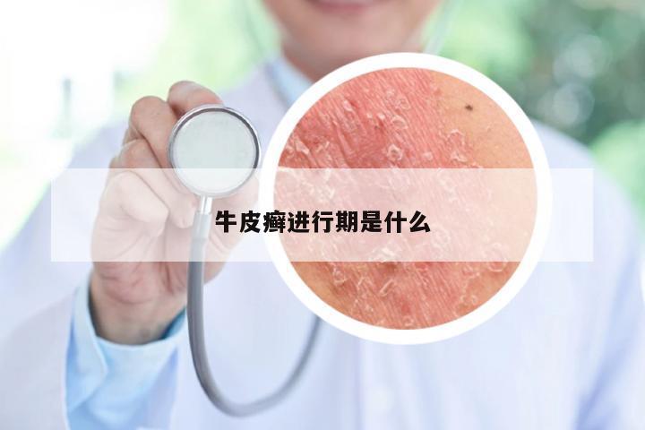 牛皮癣进行期是什么