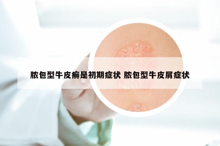 脓包型牛皮癣是初期症状 脓包型牛皮屑症状