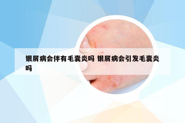 银屑病会伴有毛囊炎吗 银屑病会引发毛囊炎吗