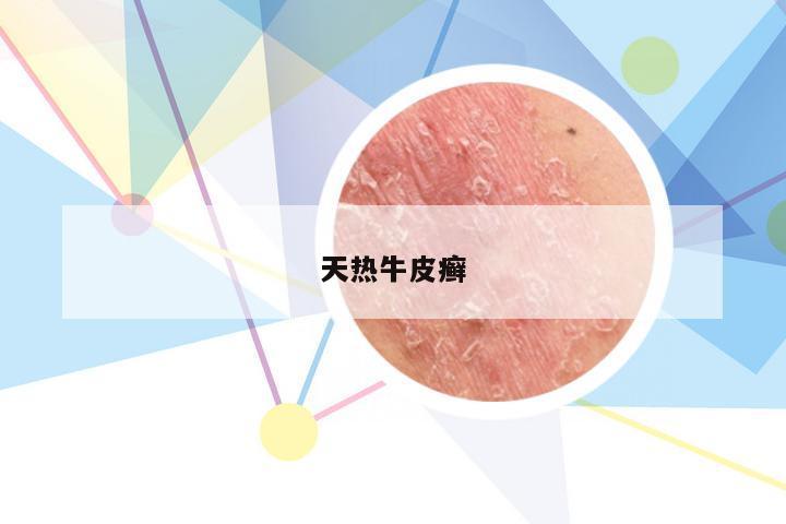 天热牛皮癣