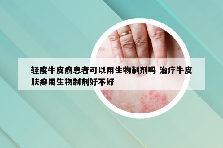 轻度牛皮癣患者可以用生物制剂吗 治疗牛皮肤癣用生物制剂好不好