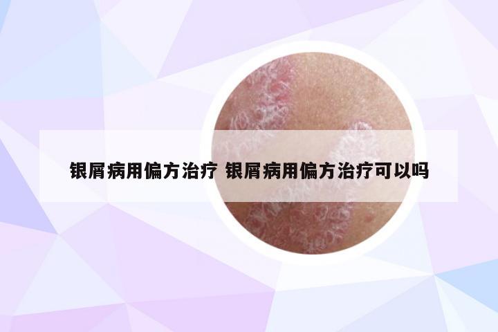 银屑病用偏方治疗 银屑病用偏方治疗可以吗